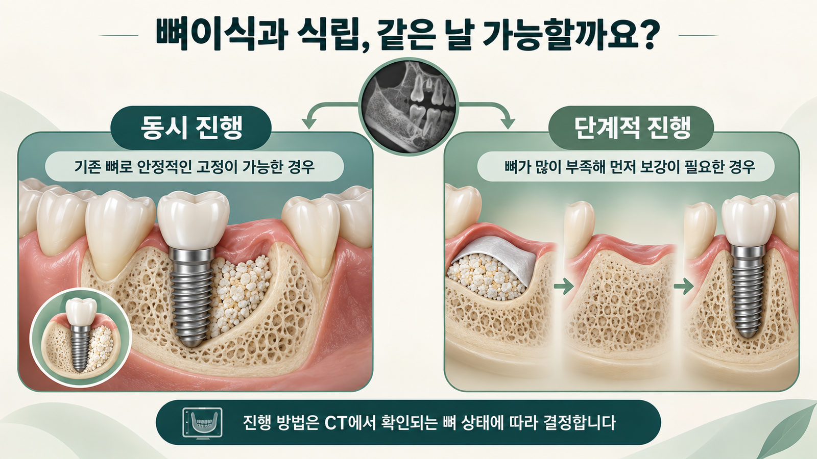 뼈이식과 식립 동시진행 단계적진행 비교 안내도
