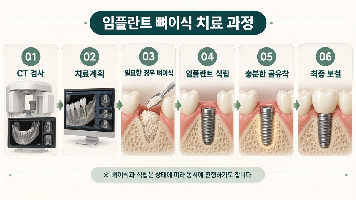 임플란트 뼈이식 치료 과정 6단계 안내도