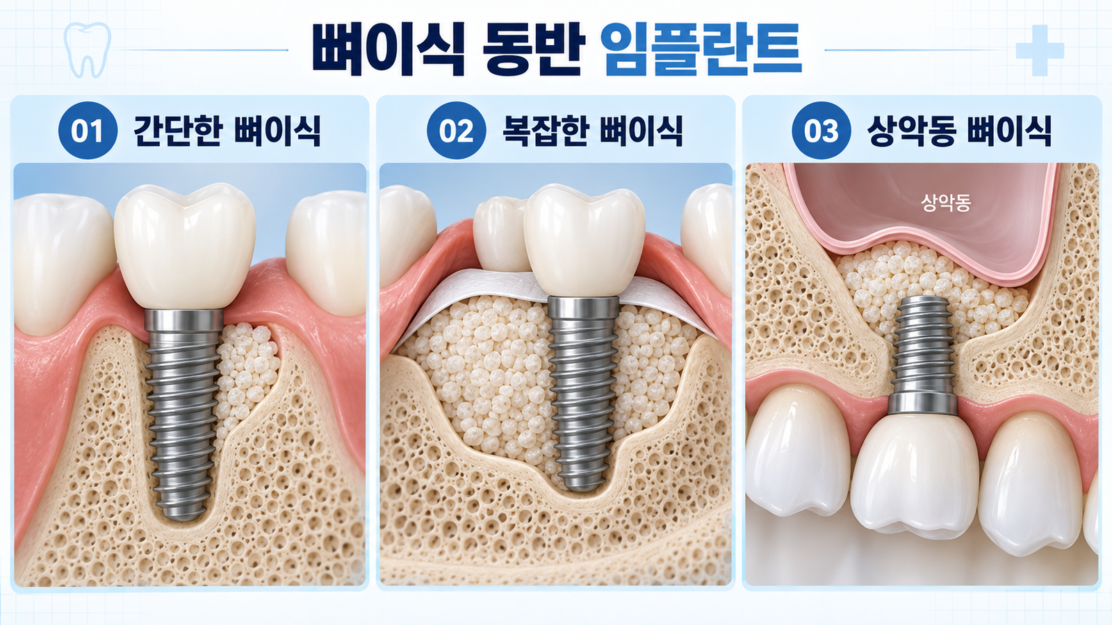 뼈이식 동반 임플란트 유형 안내도