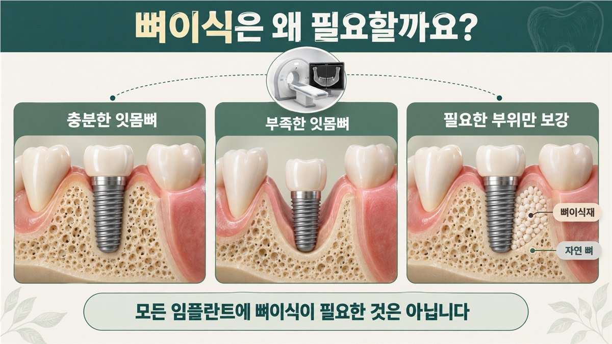 뼈이식이 왜 필요한지 설명하는 안내도