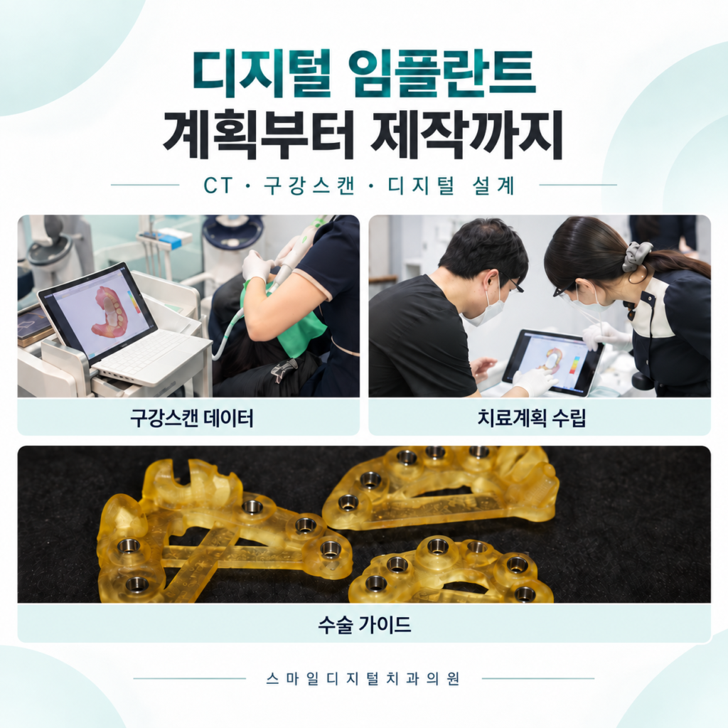 임플란트 가격에 영향을 주는 CT와 구강스캔 기반 수술 가이드 설계 과정 인포그래픽