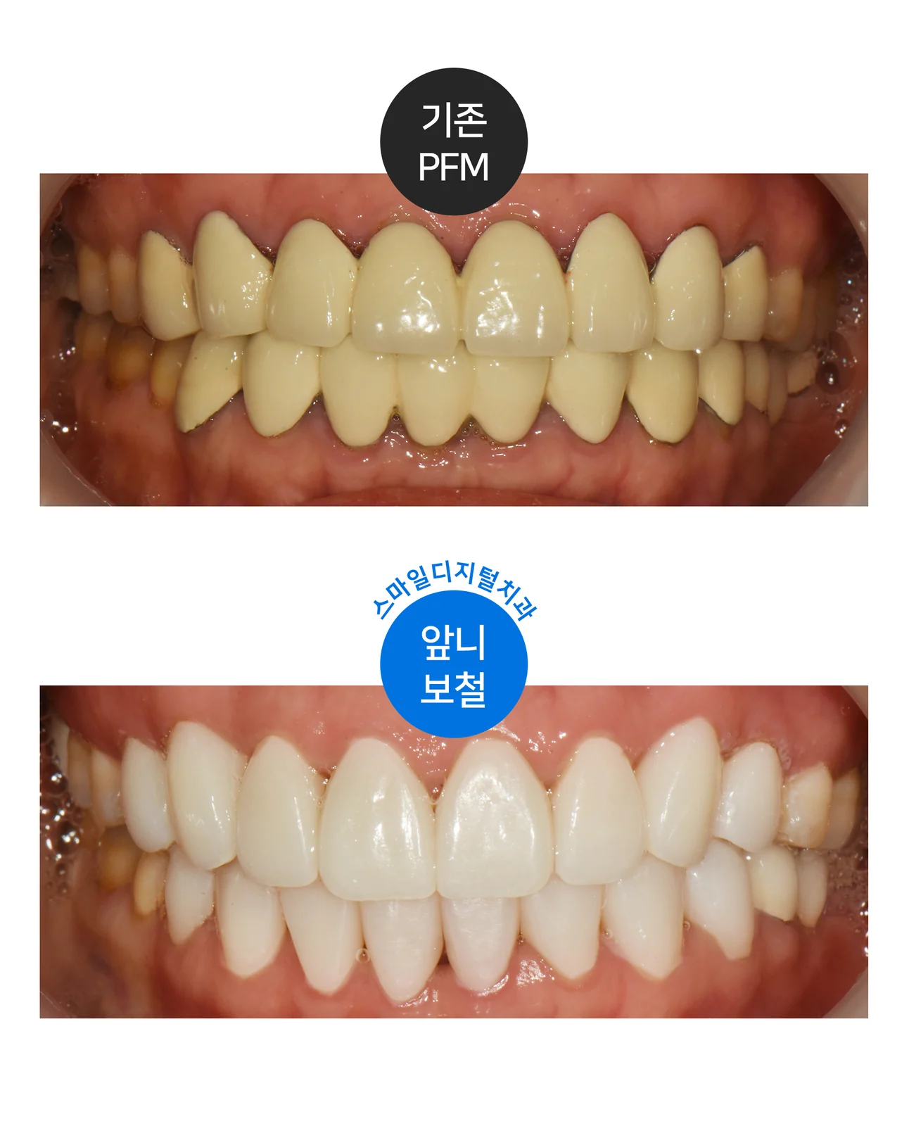 기존 PFM 보철을 앞니 보철로 교체한 전후 사진