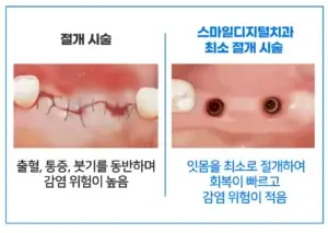 서면 임플란트 ·