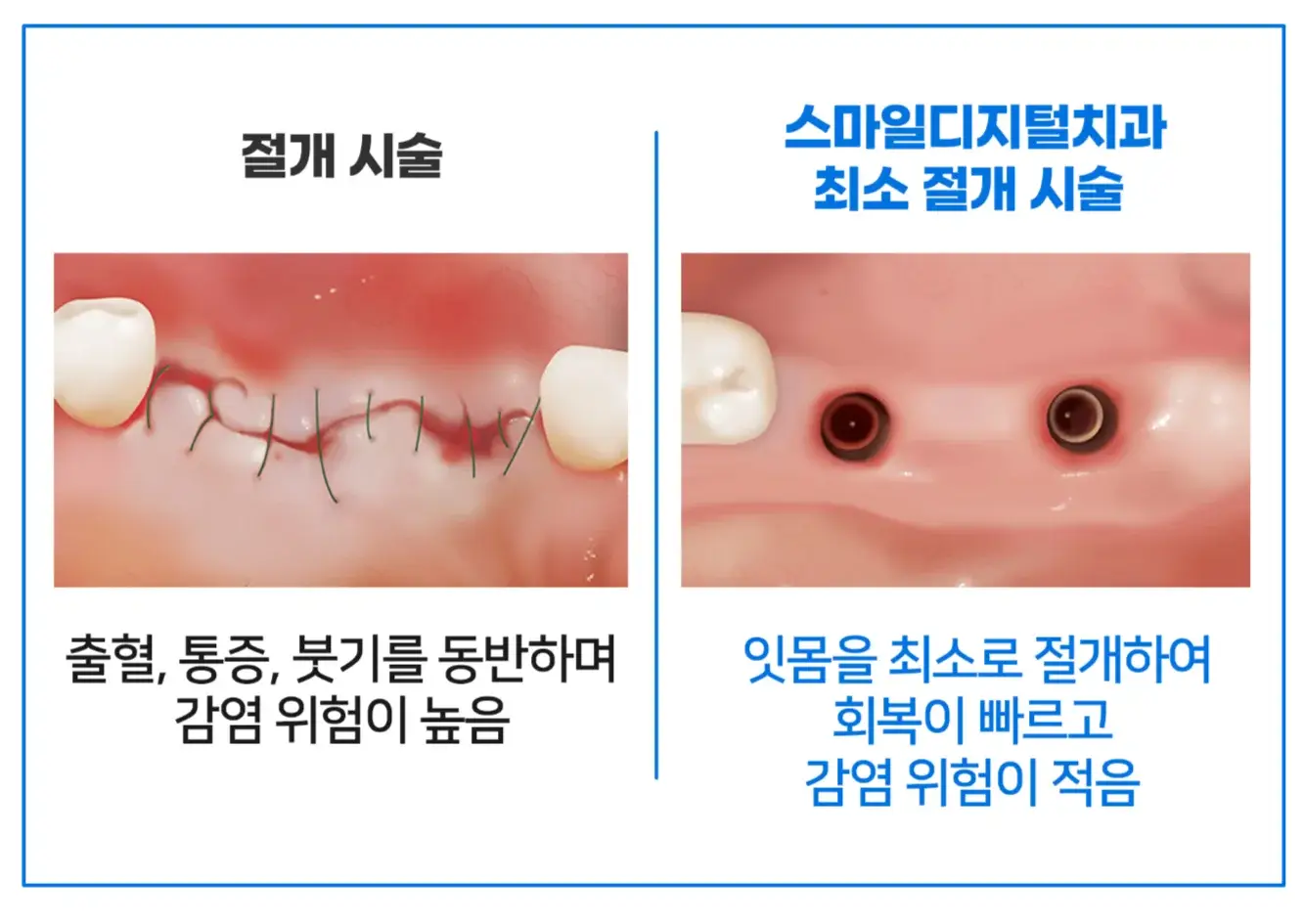 최소절개 임플란트와 기존 절개 방식 비교