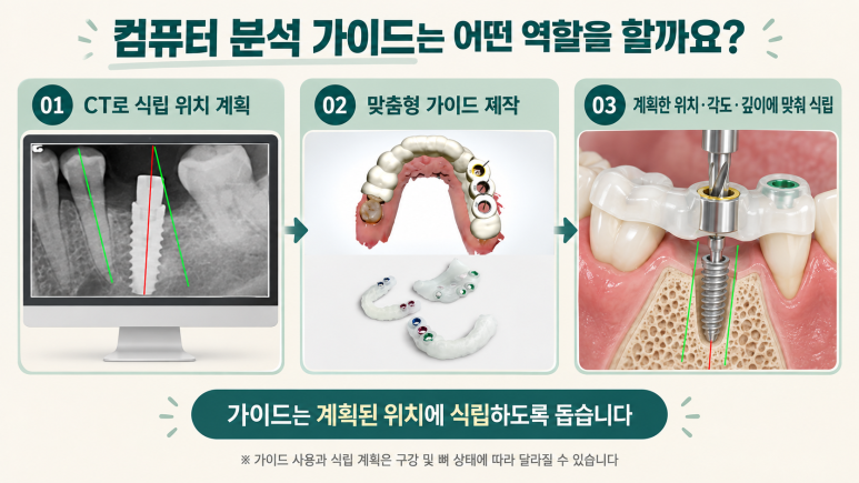 컴퓨터 분석 임플란트 가이드 수술 과정을 보여주는 이미지