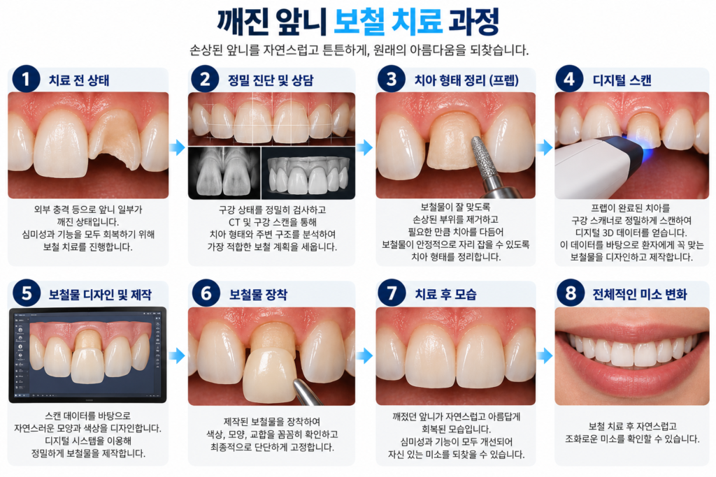 앞니가 깨졌을 때 당일 치료 가능 여부를 확인하는 보철 치료 과정 안내 그래픽
