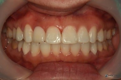 Front view of the mouth after crown and cavity treatment of an American patient