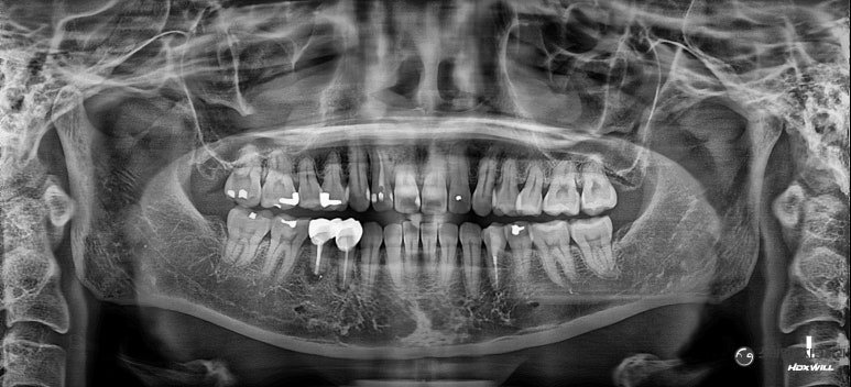 October 5, 2026 · Radiograph from the first visit