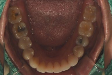 October 5, 2026 · Record of the biting surfaces of the upper and lower teeth 2