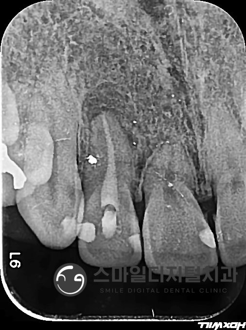 Radiograph record related to root canal retreatment of the right front tooth