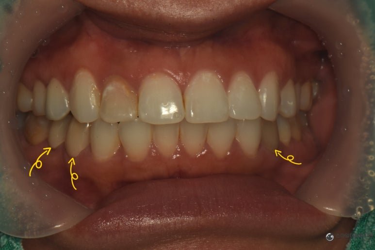 Record marking the lower premolar crown replacement sites