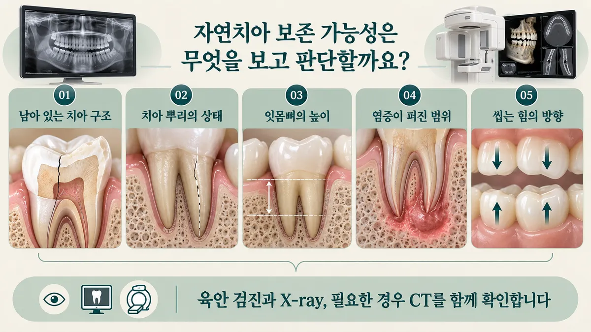 자연치아 보존 가능성 판단 기준 설명 일러스트: 남아 있는 치아 구조, 뿌리의 상태, 잇몸뼈의 높이, 염증이 퍼진 범위, 씹는 힘의 방향과 검진·X-ray·CT 확인