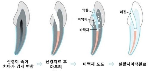 실활치 미백 과정 일러스트: 신경이 죽어 변색된 치아, 신경치료 후 마무리, 미백제 도포, 실활치 미백 완료