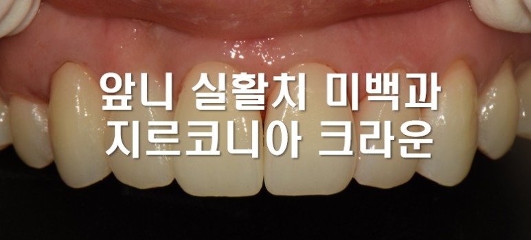 앞니 실활치 미백과 지르코니아 크라운 사례 대표 이미지