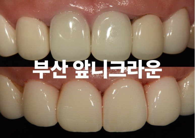 부산 앞니크라운 재치료 사례 대표 이미지