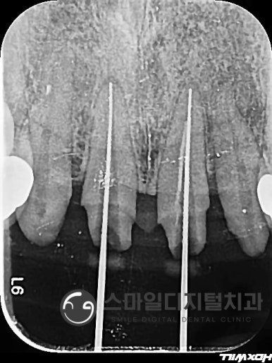 앞니 재신경치료 과정 방사선 사진 1