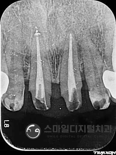 앞니 재신경치료 과정 방사선 사진 2