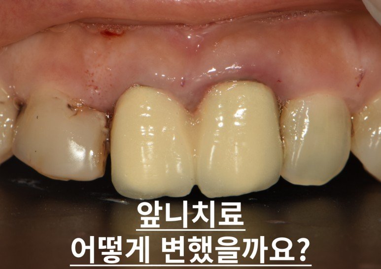 부산 앞니 지르코니아 크라운 사례 대표 이미지