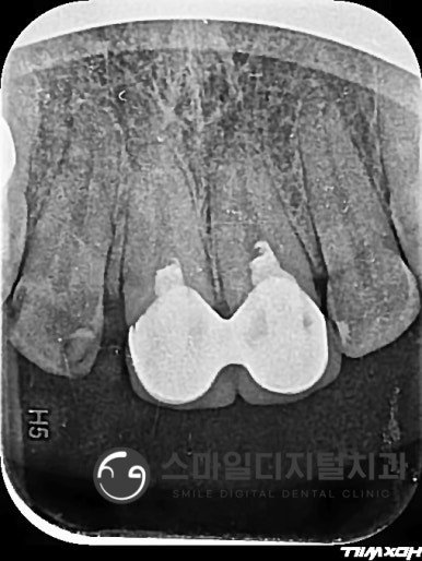 앞니 재신경치료 전 방사선 사진