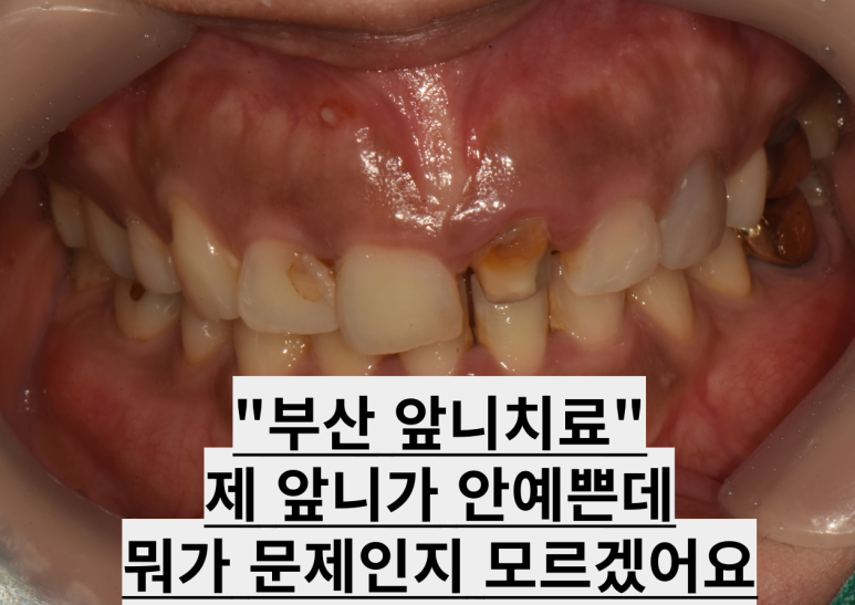 앞니크라운 잇몸성형 치료 사례 대표 이미지, 캐나다 거주 환자