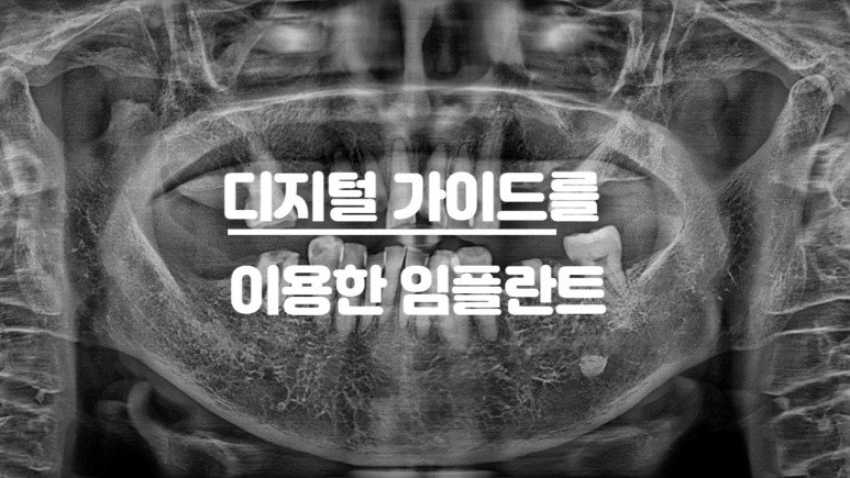 디지털 가이드를 이용한 임플란트 사례 대표 이미지