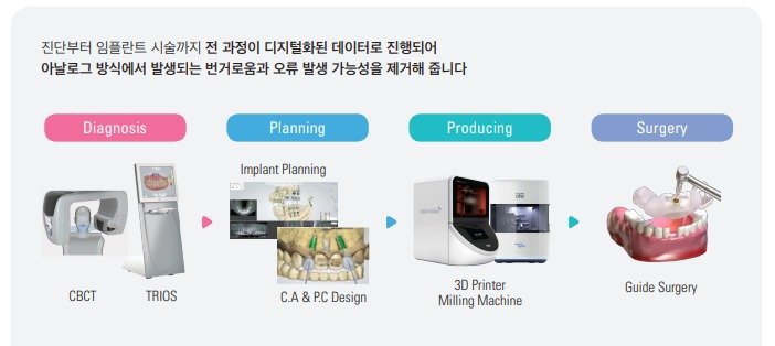 디지털 가이드 임플란트 진행 순서: 구강 내 스캔과 CT 정합, 가이드 설계, 가이드 제작, 가이드를 이용한 수술