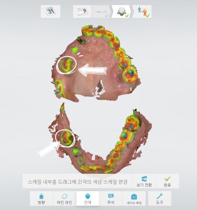 구강스캔으로 위턱 교합 접촉을 색상으로 확인한 화면