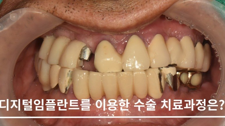 디지털 임플란트를 이용한 수술 치료과정 대표 이미지