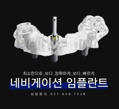 네비게이션 임플란트 수술 가이드 안내 이미지