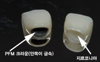 안쪽이 금속인 PFM 크라운과 지르코니아 크라운 비교 사진