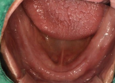 전체 임플란트 치료 전 아래턱 구강 사진