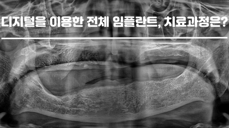 디지털을 이용한 전체 임플란트 치료과정 대표 이미지