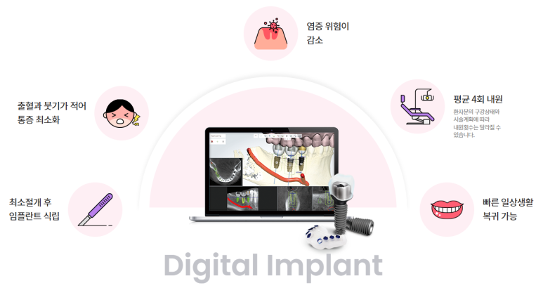 디지털 임플란트의 장점 안내 이미지