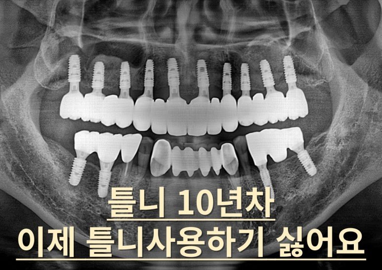 부산 틀니 10년차 전체 임플란트와 상악동 거상술 사례 대표 이미지