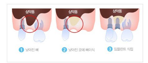 상악동 거상술 과정을 보여주는 일러스트