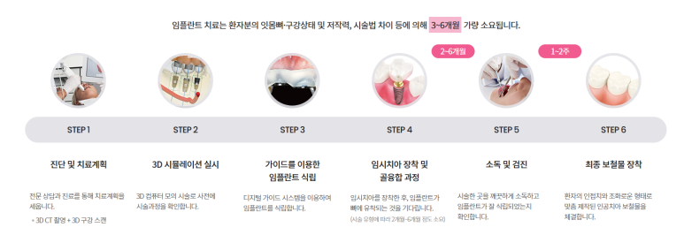 디지털 임플란트 치료 단계 안내 이미지