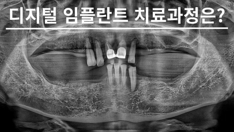 디지털 임플란트 치료과정 안내 대표 이미지