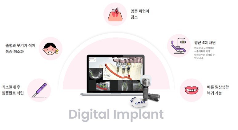 디지털 임플란트 치료 장점 안내 이미지