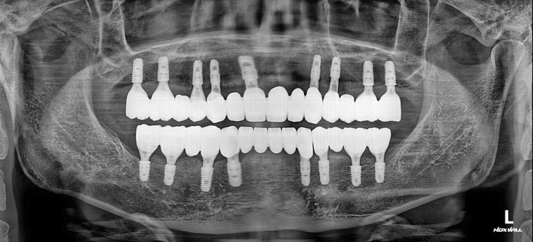 2023년 9월 22일 치료 완료 후 파노라마 X-ray