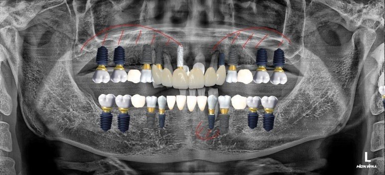 전체 임플란트 계획을 표시한 파노라마 X-ray