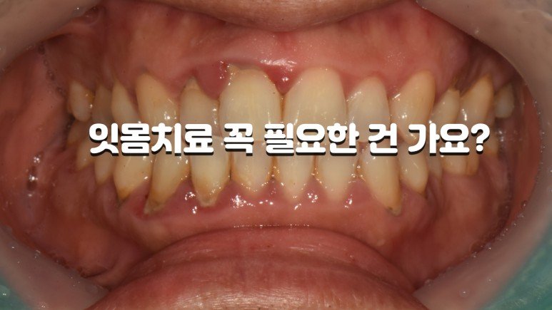 잇몸치료 꼭 필요한 건가요 피 나고 부은 잇몸 치료 사례