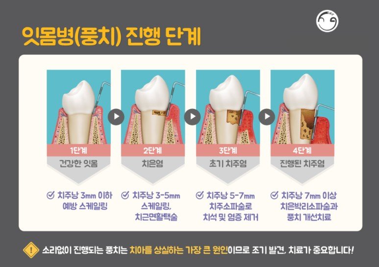 잇몸병 풍치 진행 단계 안내 이미지