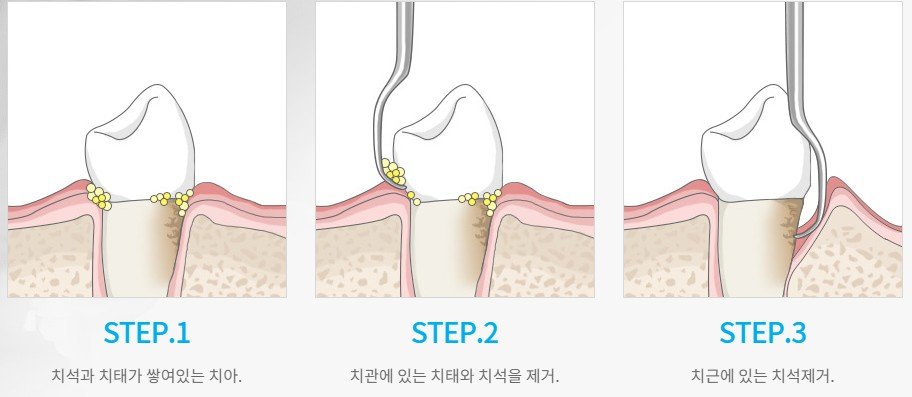 잇몸치료 진행 과정 단계별 일러스트