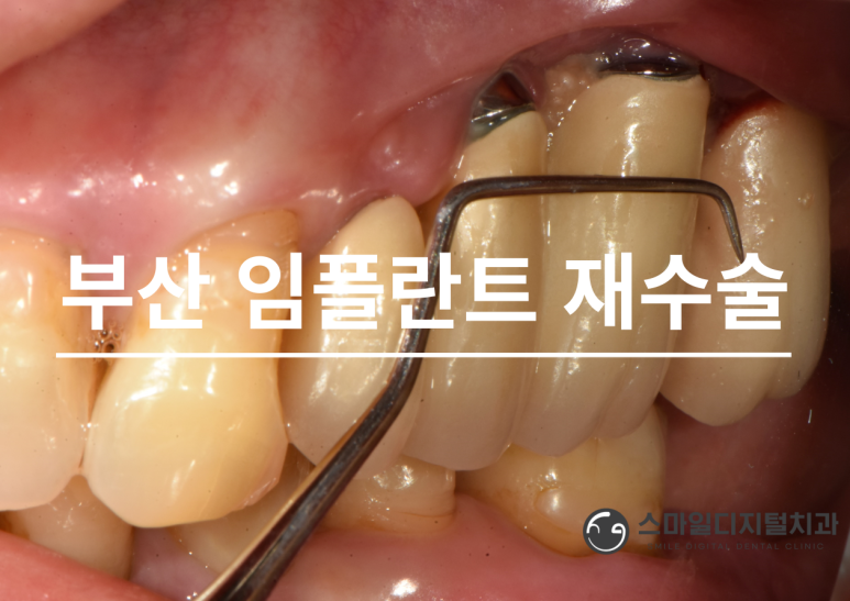 임플란트 재수술 치료 사례 대표 이미지