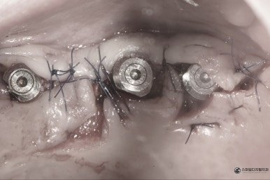 2차 수술 후 임플란트 힐링 어버트먼트 사진 1