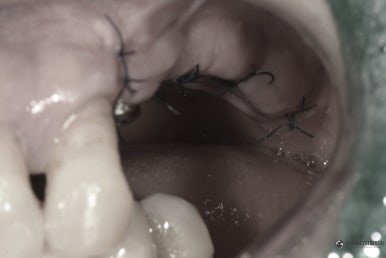 2차 수술 후 임플란트 힐링 어버트먼트 사진 2