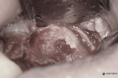 임플란트 재수술 중 치조골이식술 부위