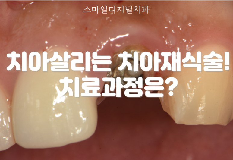치아재식술 치료과정 안내 대표 이미지