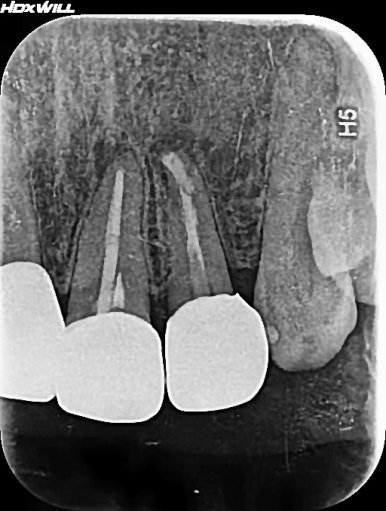 치아재식술 후 9개월 X-ray