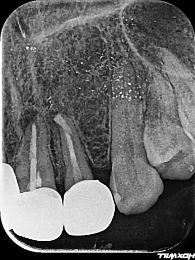 치아재식술 후 크라운 치료 직후 X-ray